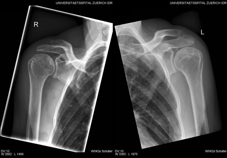 periarthritis shoulder physiotherapy